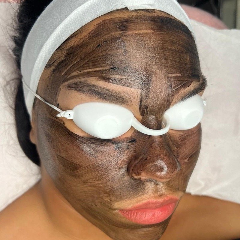 Carbon Peel